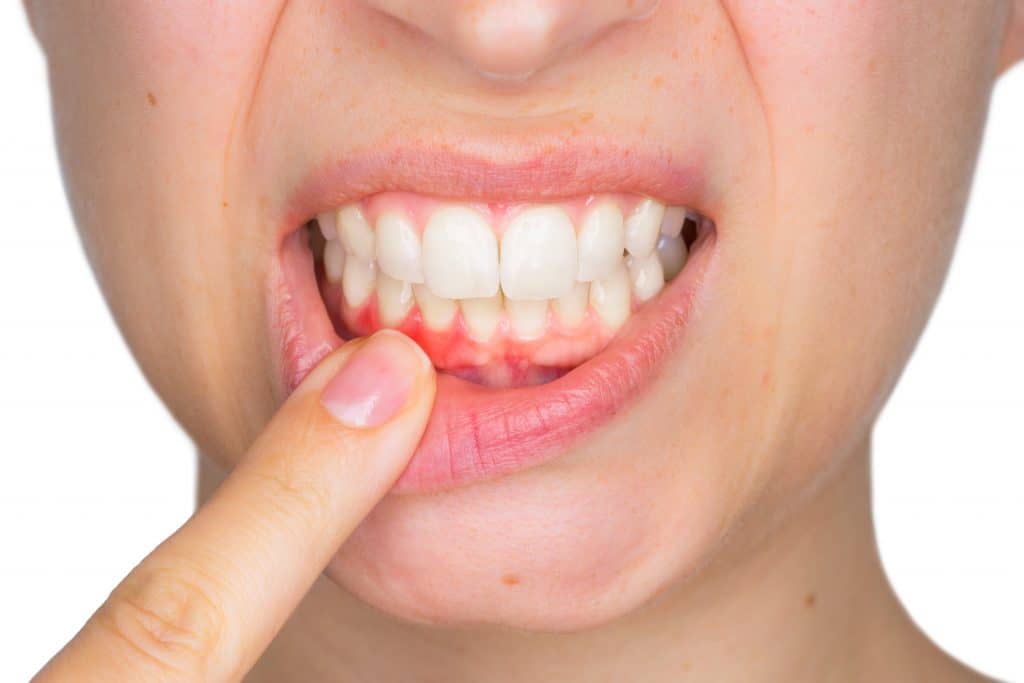 a lady showing signs of receding gums