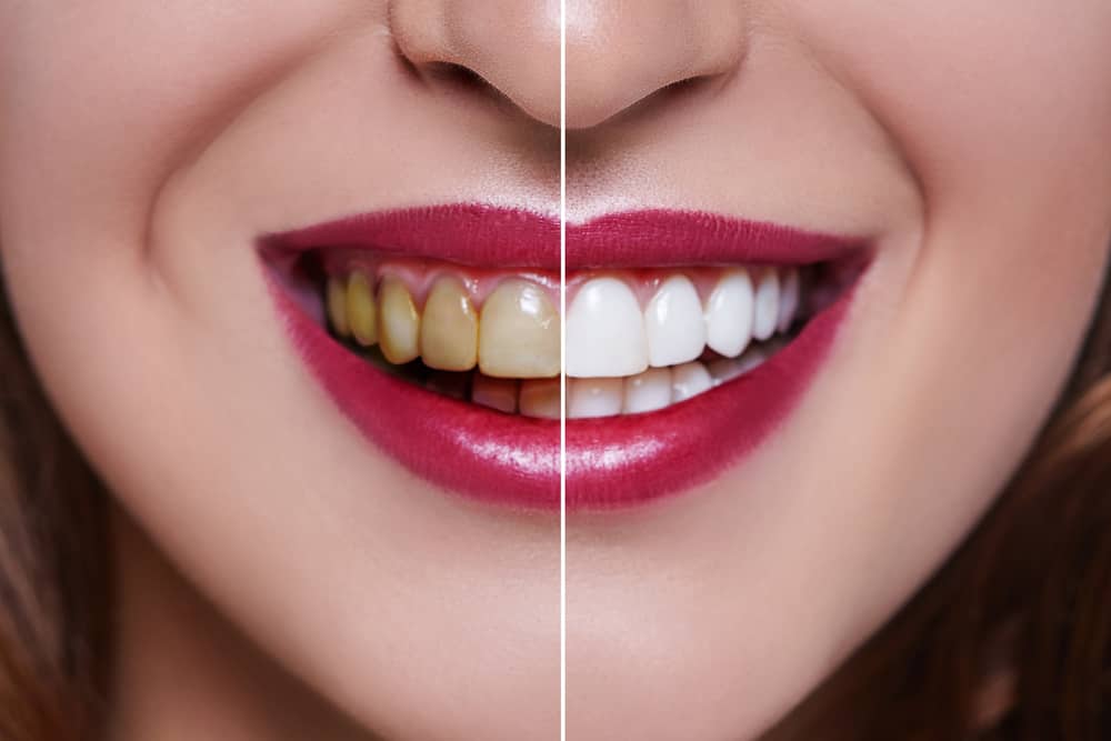 before and after results of white teeth