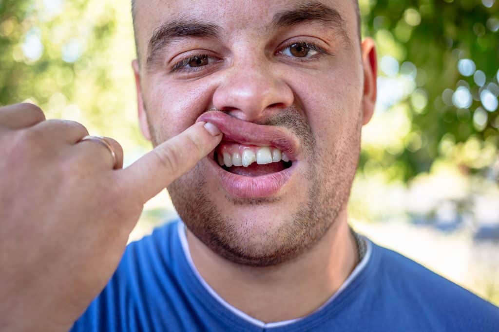 a man holding his lip displaying a broken tooth