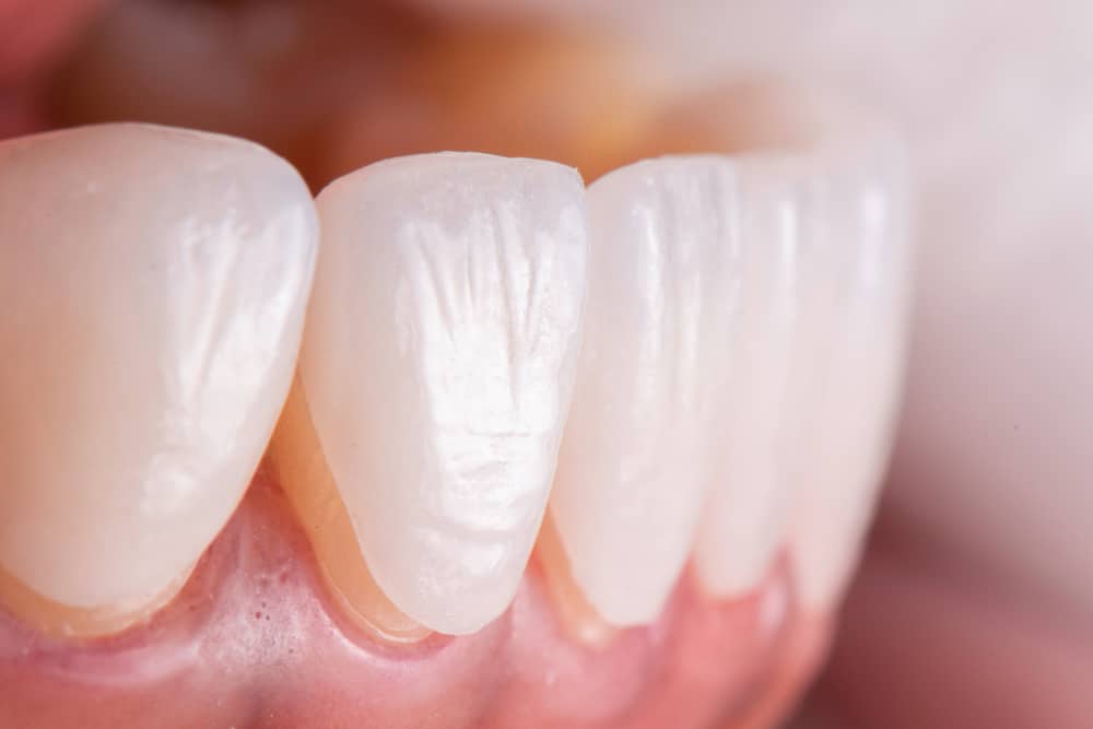 Porcelain Veneers