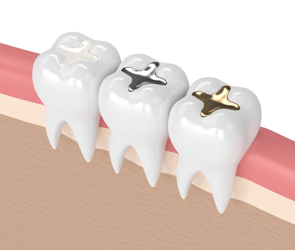 How To Know Which Dental Filling Is Best For Me?