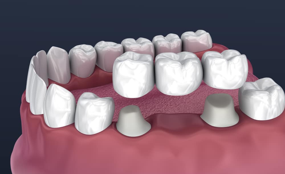 Tooth supported fixed bridge of 3 teeth. Medically accurate 3D illustration