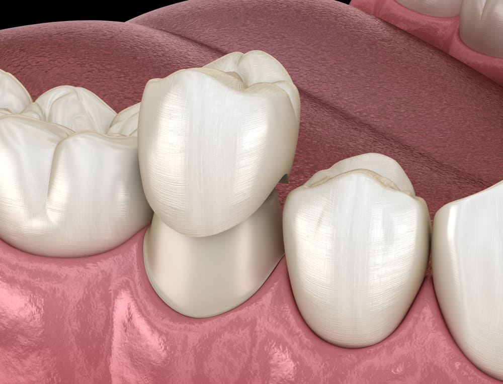What Are Dental Crowns, And How Are They Placed