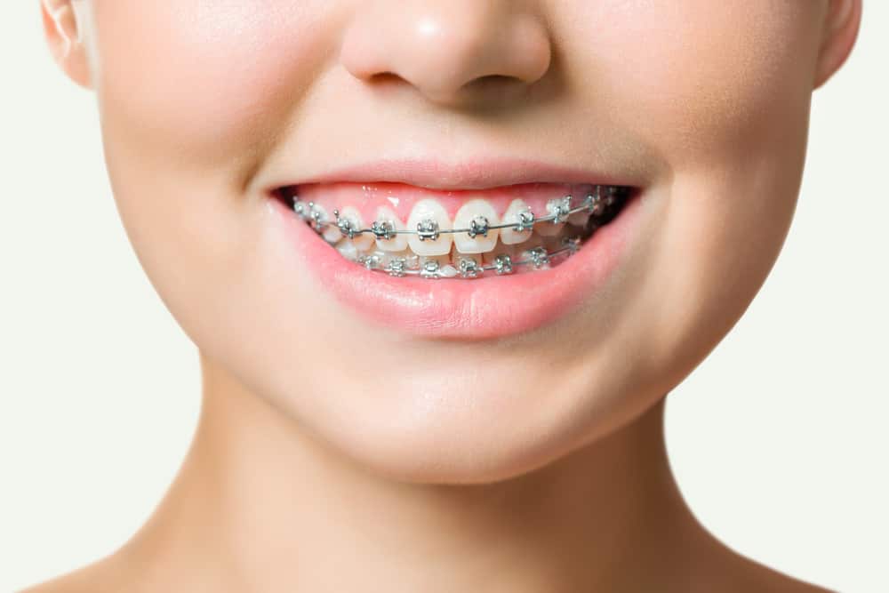 Braces Cost