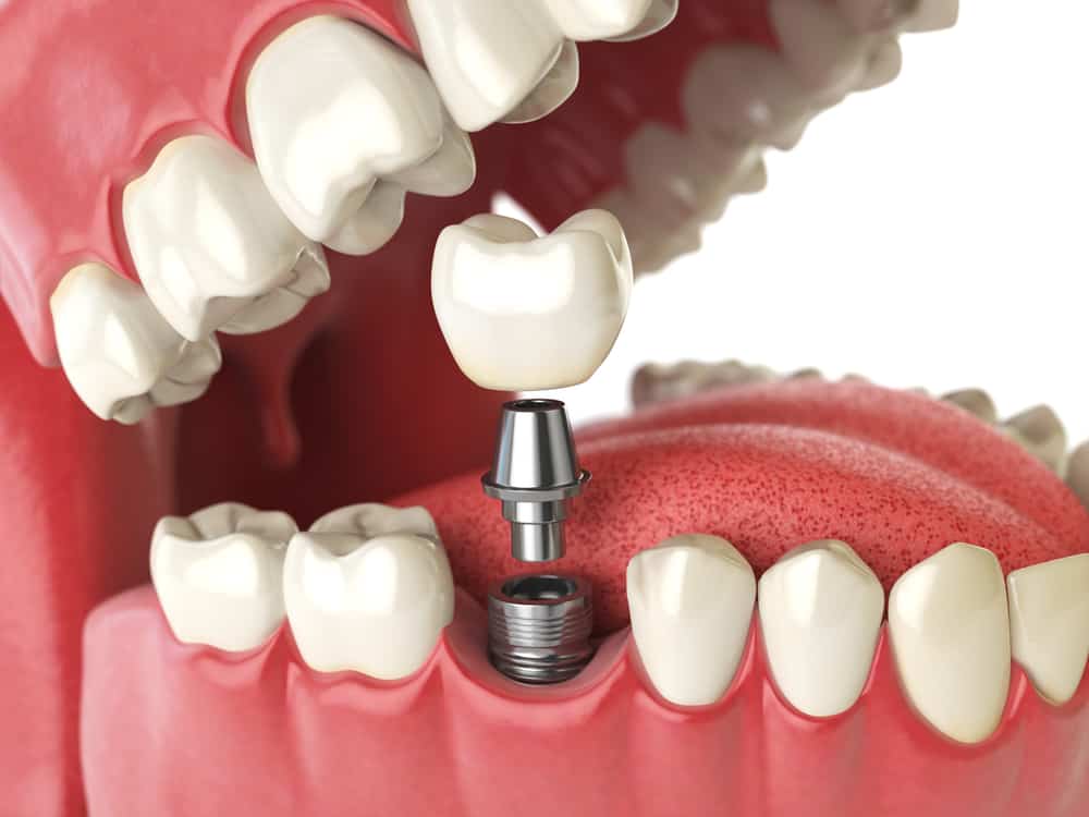How Long Does Dental Implant Last?