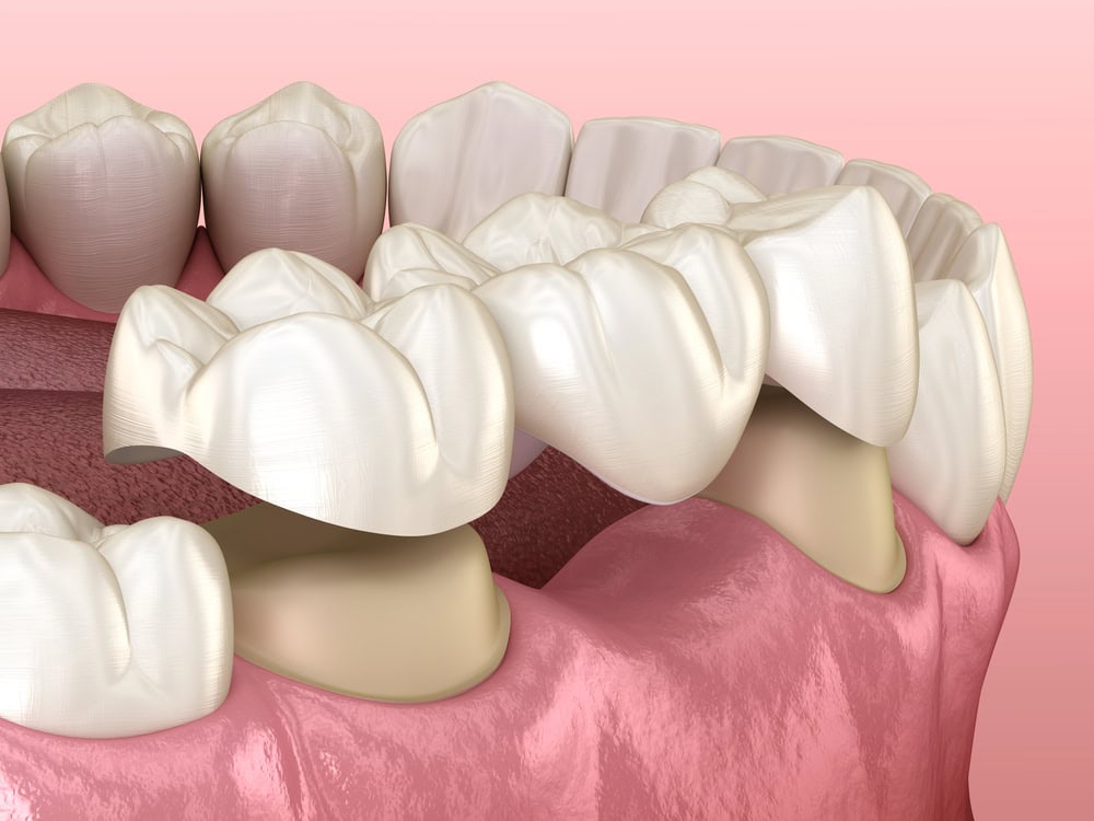 Dental Bridges Restore Sunbury