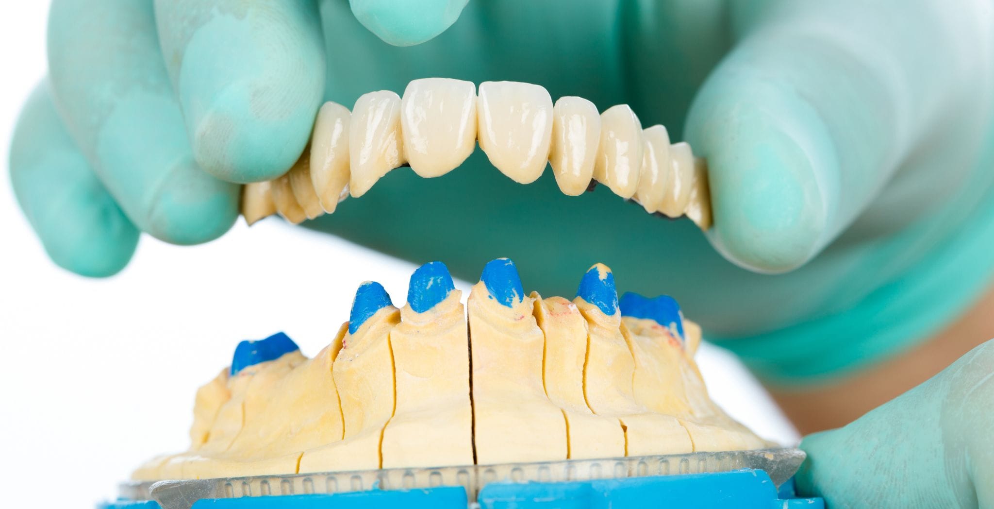 Dental bridge, Dental bridge procedure, Benefits of dental bridge, Types of dental bridges, Fixed dental bridge, Dental bridge for missing teeth, Dental bridge treatment, Dental bridge vs implant,