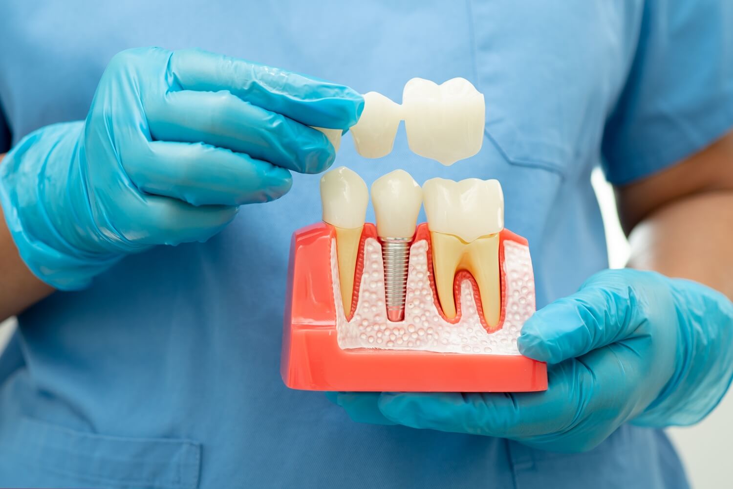 dentist showing dental bridge dental crown sample