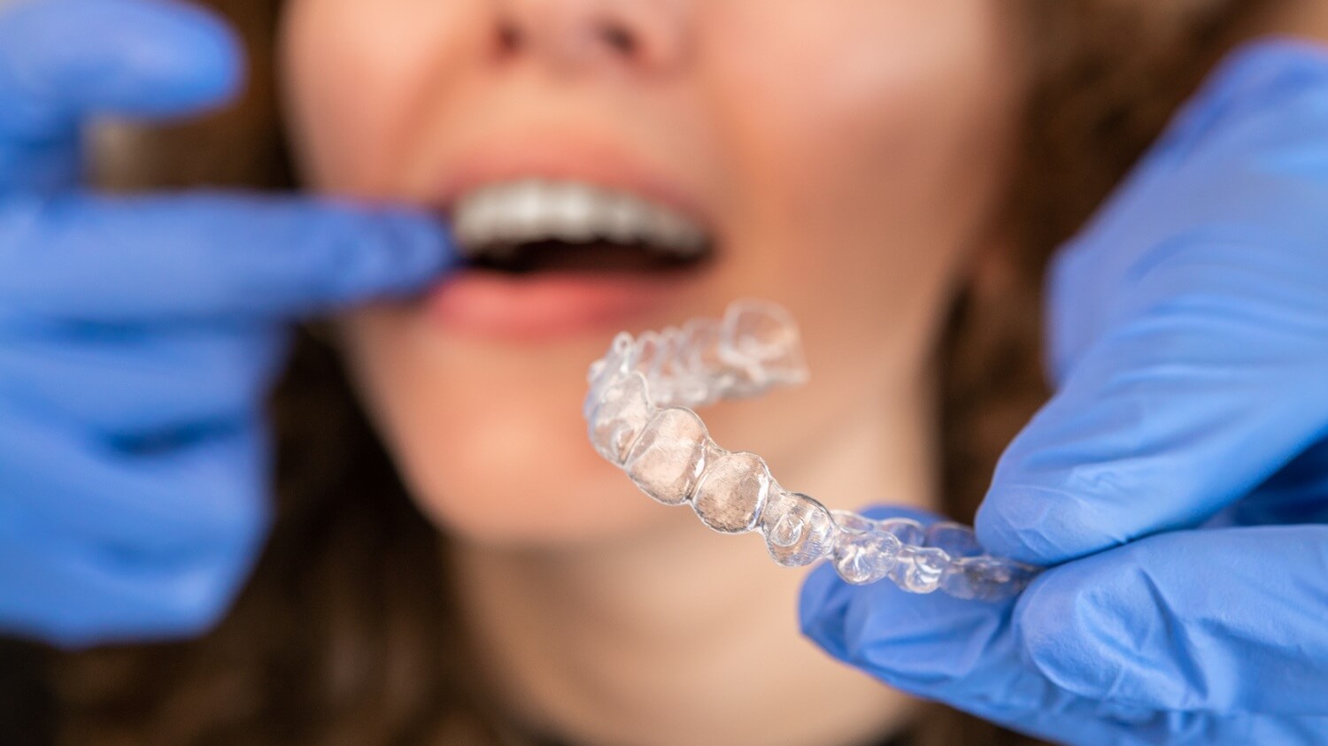 orthodontics showing to a female patient a clear aligners