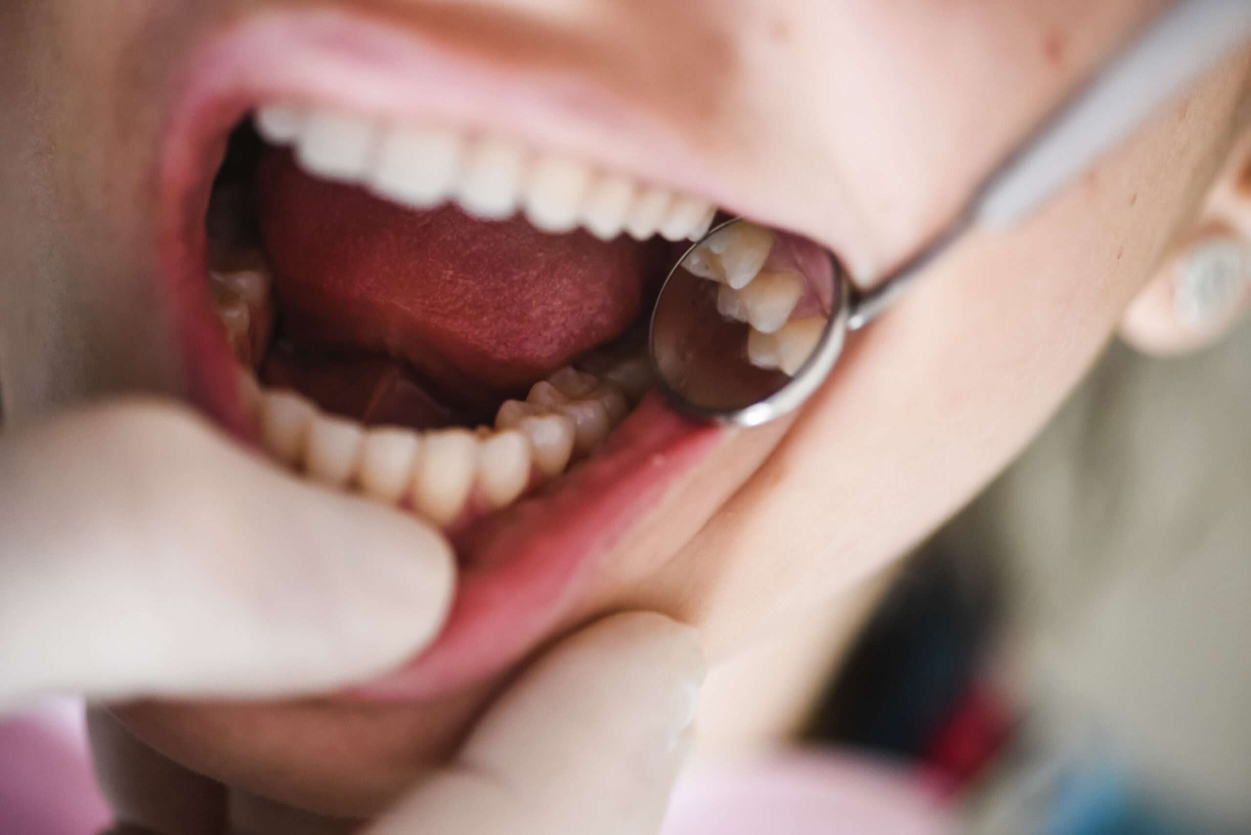 Dentist using a mouth mirror to check a patient's teeth and gums during an examination for gum disease